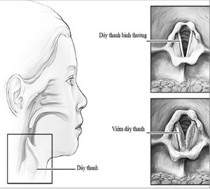 Vị trí, cấu tạo dây thanh.