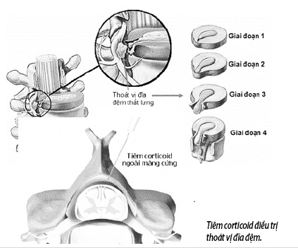 Tiêm corticoid điều trị thoát vị đĩa đệm.