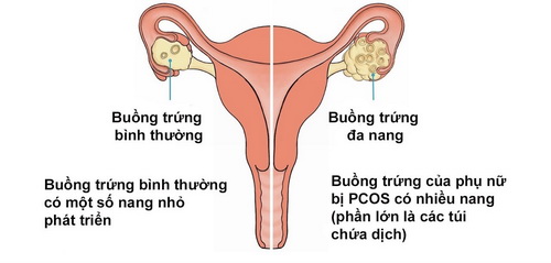 Hình ảnh buồng trứng bình thường (trái) và khi bị buồng trứng đa nang (phải).