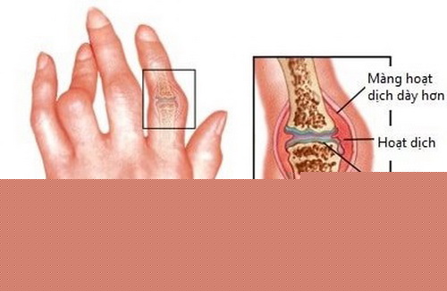 Biểu hiện viêm khớp dạng thấp ở ngón tay.