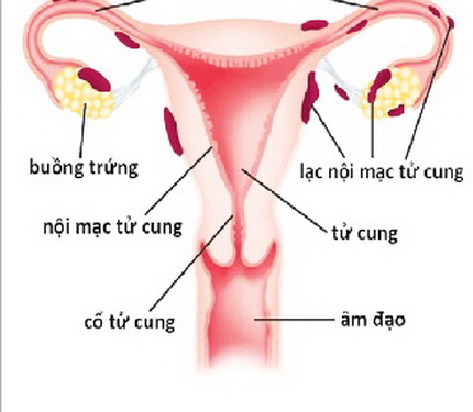 Lạc nội mạc tử cung.