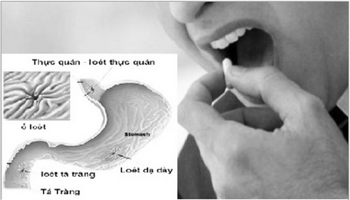 Thuốc có thể gây viêm loét dạ dày thực quản.