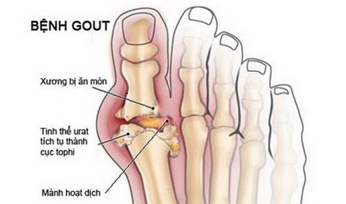 Những biến đổi tại khớp ngón chân cái trong bệnh gút.