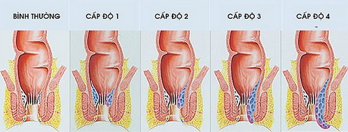 Tùy vào cấp độ bệnh bác sĩ sẽ chỉ định cách điều trị phù hợp.