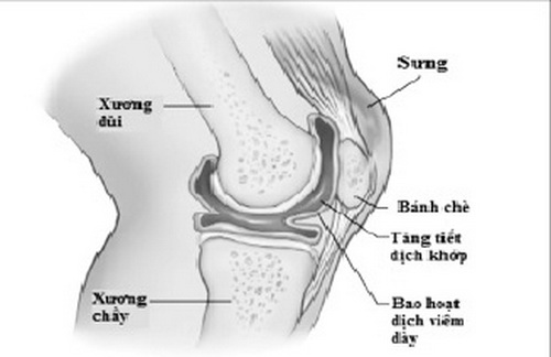 Tràn dịch khớp gối.