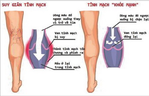 Khí huyết không được lưu thông gây suy giãn tĩnh mạch.