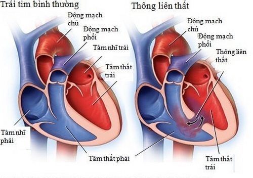 Thông liên thất là bệnh lý tim bẩm sinh.