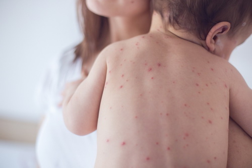 Cần đưa trẻ đến bệnh viện khi trẻ sốt phát ban kèm ho.