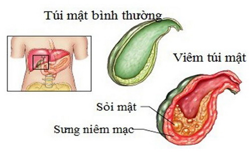 Hình ảnh túi mật bị viêm.