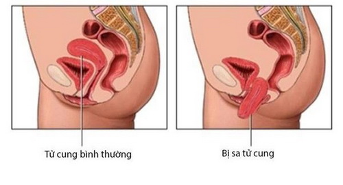 Bệnh sa sinh dục: Những điều cần biết