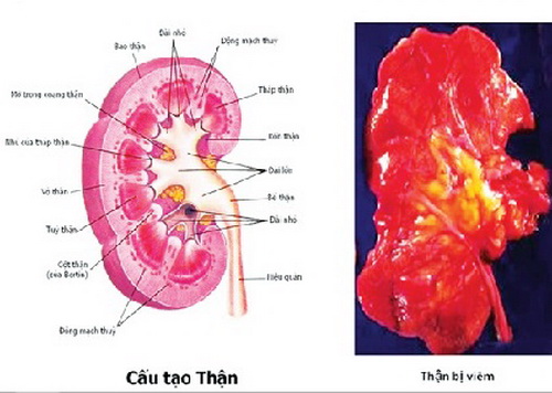 Viêm cầu thận mạn thuộc phạm vi chứng thủy thũng (thể âm thủy) của y học cổ truyền. Bệnh có nguy cơ biến chứng suy thận, ảnh hưởng rất lớn đến sức khỏe.