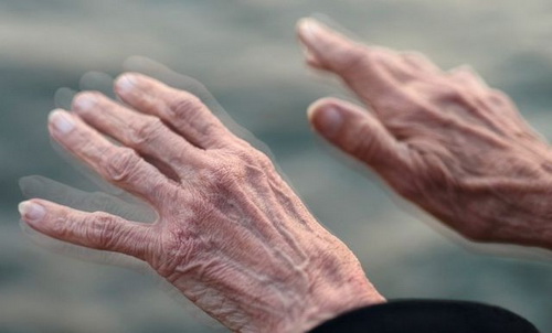 Run tay là một dấu hiệu sớm của bệnh Parkinson.