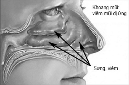 Viêm xoang dễ bị tái phát