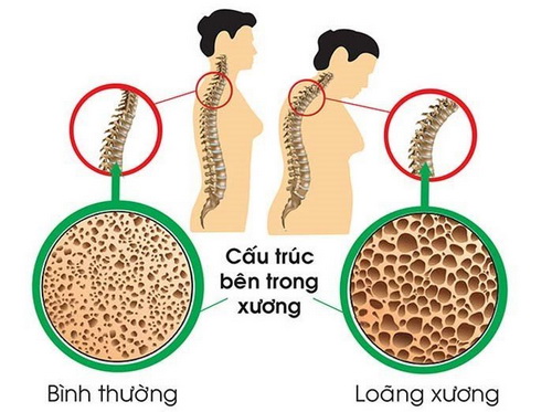 Loãng xương rất hay gặp ở người cao tuổi và phụ nữ, gây nhiều biến chứng nguy hiểm, đặc biệt là gãy cổ xương đùi.