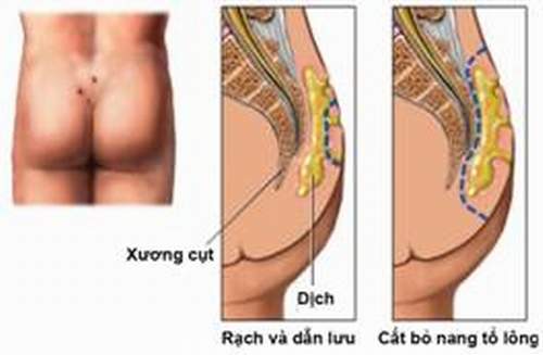 Nang tổ lông ở trên xương cùng cụt (trái) và ổ áp-xe nang tổ lông (phải).
