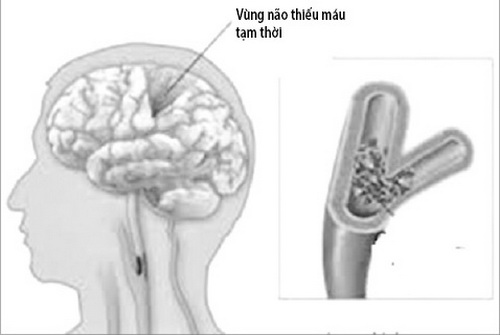 Thiếu máu não hay gặp ở người trung niên và người cao tuổi.