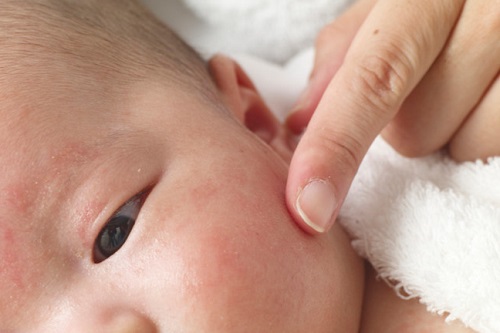 Triệu chứng rắc rối nhất của chàm là ngứa ngáy khó chịu, làm cho bệnh nhi quấy khóc liên tục, không chịu ngủ.