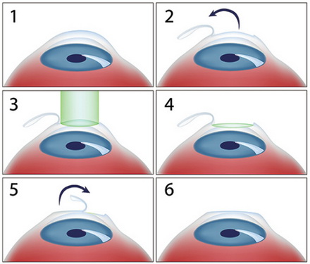 Các bước trong phương pháp phẫu thuật Lasik.