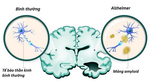 Nhờ hình ảnh PET amyloid, có thể phát hiện các mảng não của Alzheimer ở người sống.