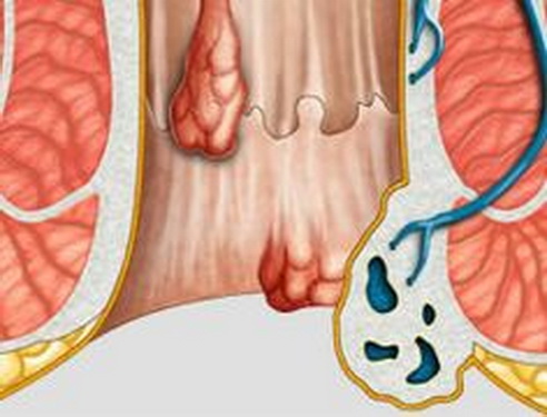 Trĩ gây đau đớn, ảnh hưởng tới cuộc sống hằng ngày của người bệnh.