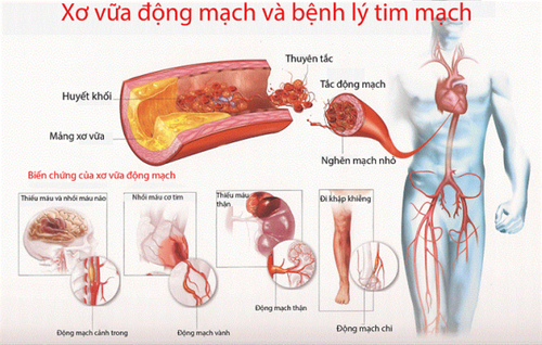 Biến chứng bệnh mạch vành: Nguyên nhân, triệu chứng và phòng ngừa