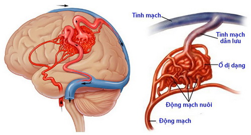 Dị dạng mạch não: Bệnh nguy hiểm, dễ nhầm lẫn