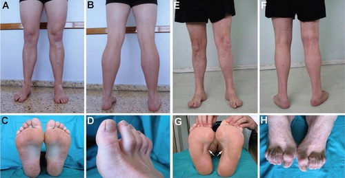 Một số biểu hiện tổn thương khớp trong bệnh Charcot - Marie - Toot.