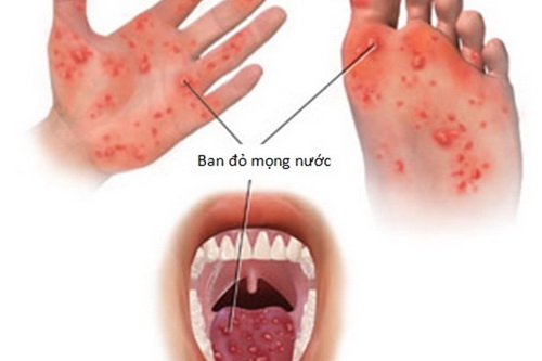 Hình ảnh bệnh tay - chân - miệng.