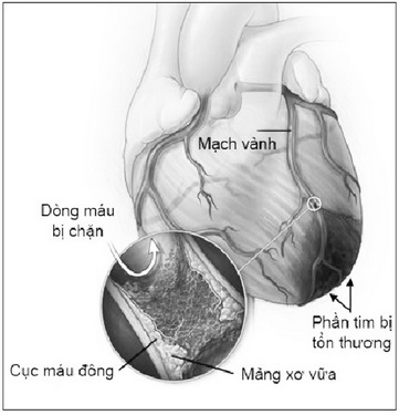 Nguy cơ do nhồi máu cơ tim.
