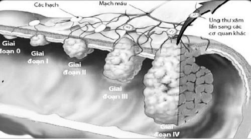 Các giai đoạn của ung thư đại tràng.