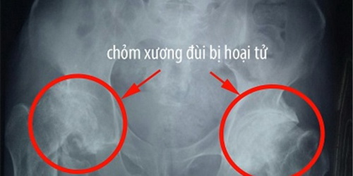 Tổn thương cơ bản của bệnh là hoại tử nhân của chỏm xương đùi.