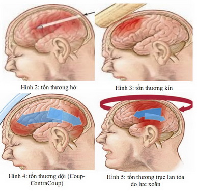 Tổn thương não khi bị chấn thương sọ não.