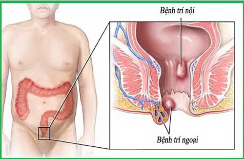 Đề phòng bệnh trĩ nên ăn nhiều rau xanh để cung cấp chất xơ, cải thiện hệ tiêu hóa.