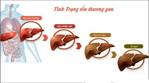 Lạm dụng rượu bia sẽ dẫn đến tổn thương gan gây ra những bệnh lý ở gan.