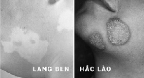 Cần phân biệt lang ben và hắc lào.