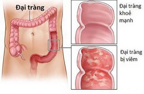 Hình ảnh đại tràng khỏe mạnh và đại tràng bị viêm.