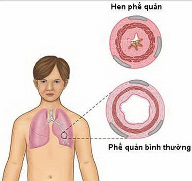 Cần kiểm soát và điều trị bệnh hen tránh để bệnh biến chứng.