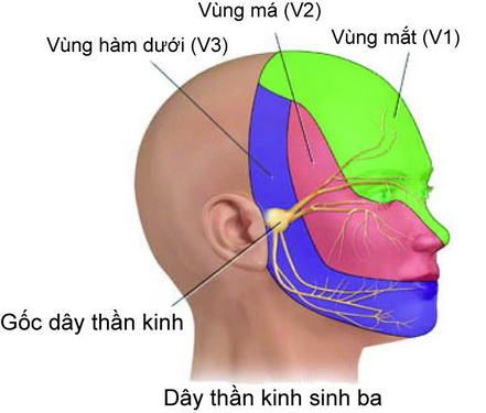 Đau dây thần kinh số V thường gặp ở vùng mặt - miệng.