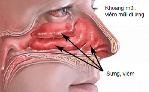 Một số triệu chứng khi bị viêm mũi dị ứng.