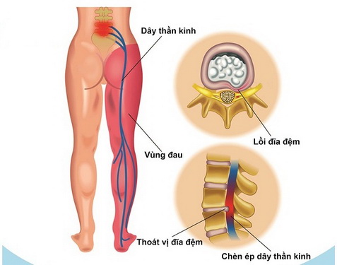 Đau thắt lưng do nhiều nguyên nhân gây ra.