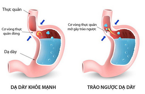 Hình ảnh trào ngược dạ dày.