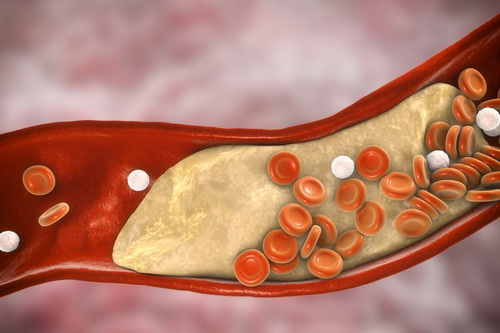 Nồng độ cao cholesterol gây nhiều hệ lụy cho sức khỏe.
