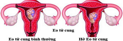 Hở eo tử cung có thể gây sẩy thai sớm.