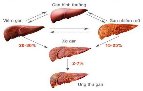 Tiến triển của bệnh gan qua các giai đoạn.