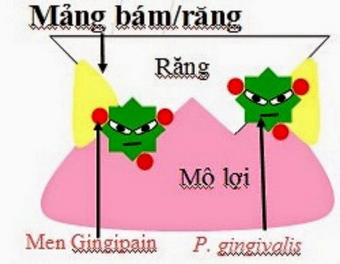 Mảng bám răng là nguyên nhân gây viêm nướu.