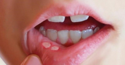 Loét miệng ở trẻ khiến việc nuôi dưỡng và chăm sóc khó khăn. Loét miệng ở trẻ khiến việc nuôi dưỡng và chăm sóc khó khăn.