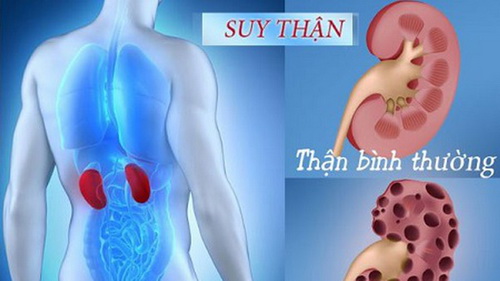 Suy thận mạn tính là một bệnh lý nặng và thường dẫn tới nhiều biến chứng làm giảm tuổi thọ.