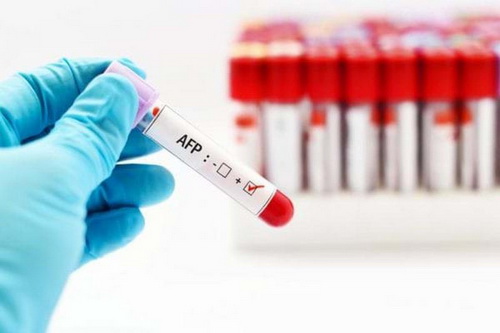 Có thể phát hiện ung thư gan qua xét nghiệm định lượng AFP.