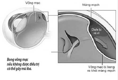 Bong võng mạc nếu không được điều trị có thể gây mù loà.