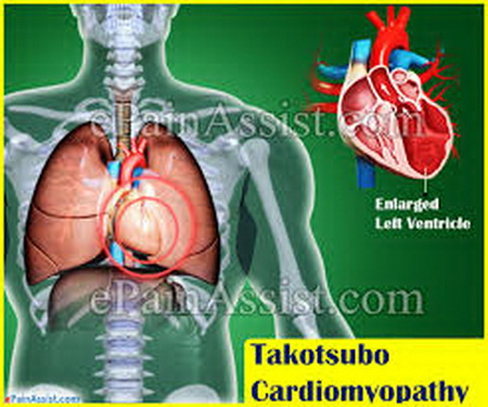 Hội chứng BHS, một trong những thủ phạm gia tăng bệnh tim ở phụ nữ.